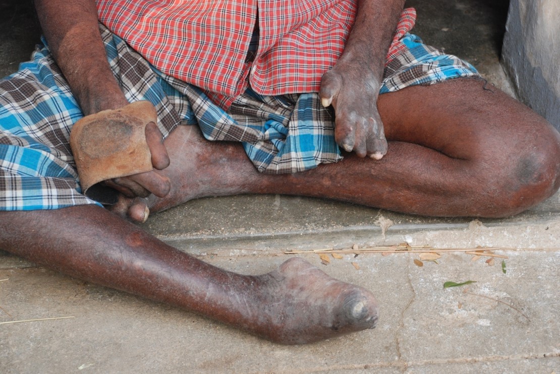 World Leprosy Day